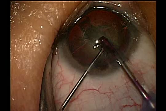 Phaco for Complex Cases: Choosing a System to Meet Your Practice Needs