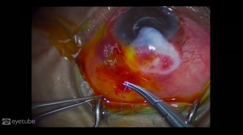 Excision of Dissecting Bleb