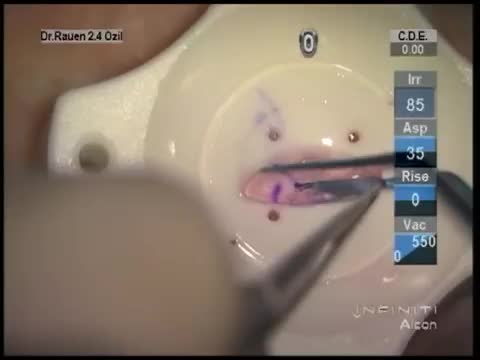 DSAEK Partial Thickness Cornea Transplant