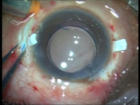 Live Surgery of Glued IOL
