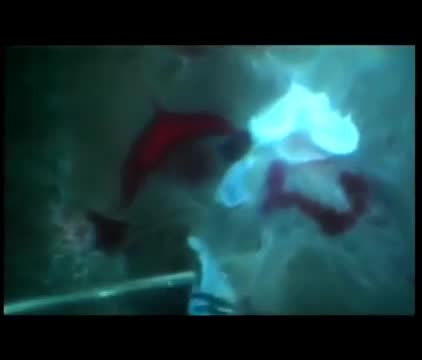 Tractional Retinal Detachment with 27G 