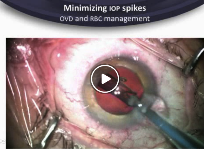 MIGS: Glaukos iStent User Group: Case Studies - Part 2