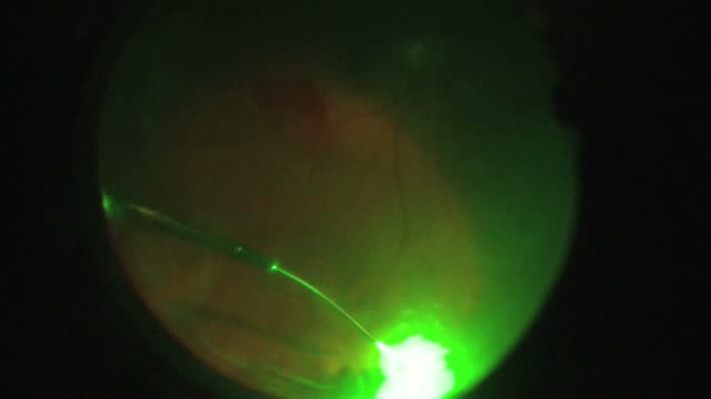 27 Gauge Pars Plana Vitrectomy