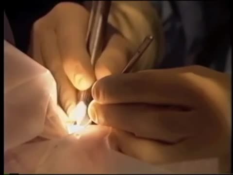 Surgeon's Hand Position During Cataract Surgery: Pearls For Residents 