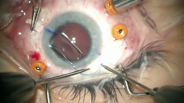 Haptic Tuck-Modified Scleral Glued Technique