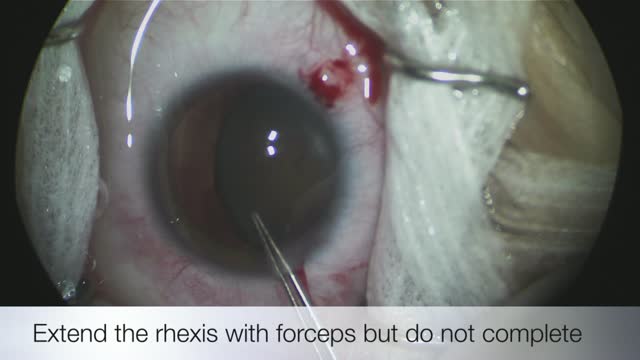 Subluxated Cataract in a Marfan Patient 