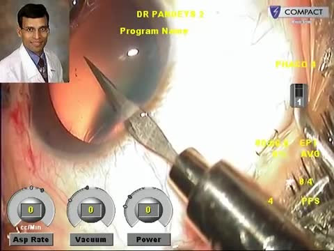 Refractive Lens Exchange With Multifocal IOL Implantation