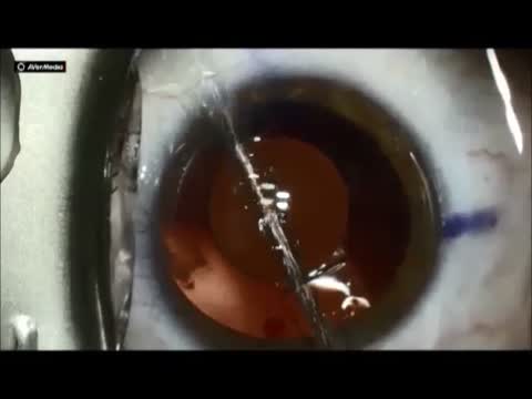 Trulign Insertion