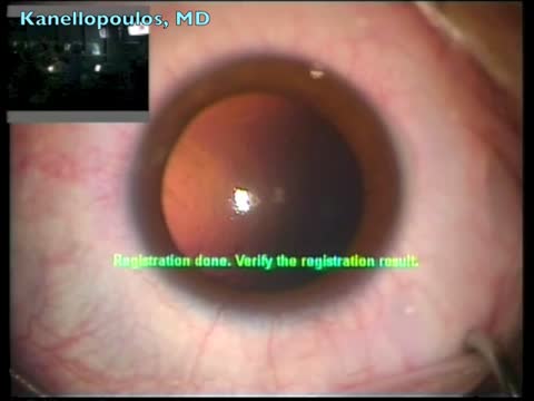 Toric Visian ICL Implantation 