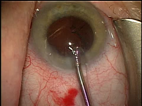 Red Cataract Removal with the Catalys Laser