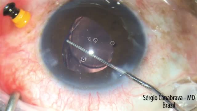Double-Needle Intrascleral Fixation With Iris Expansion Ring