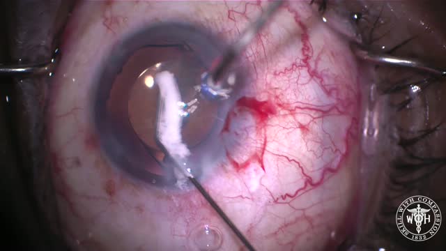 Traumatic Cataract With 2 CTRs and Cerclage Suture