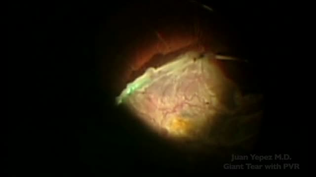 Surgical Strategy for Management of Giant Tear with PVR