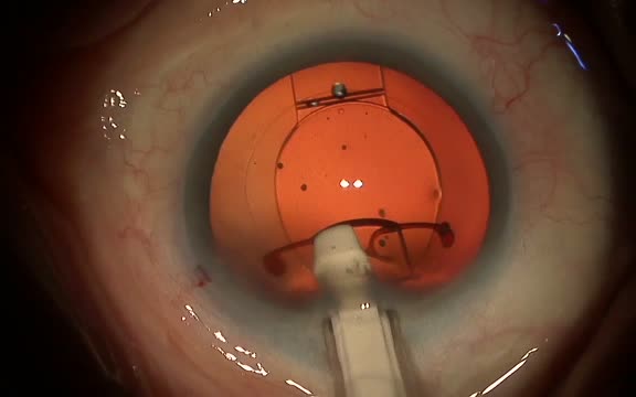 Trulign Implantation