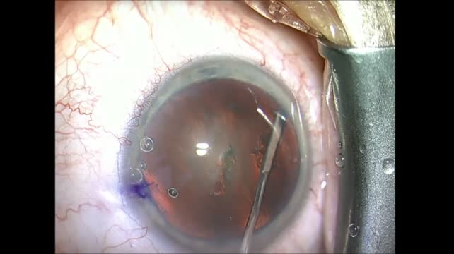 Supra Capsular Technique - Lens Not Flipping Down 