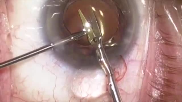 IOL Exchange with Advanced Haptic Stripping