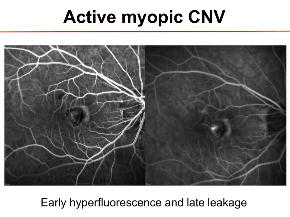 OCT-A for Determining Disease Features in Pathologic Myopia