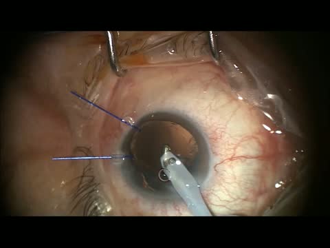 Traumatic Subluxated Cataract Extraction