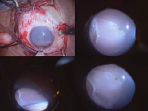 Chandelier Assisted Scleral Buckling