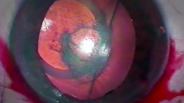 Decubitus of the Anterior Capsule of the Lens