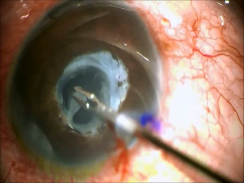 Removal of Multi-Layered Occlusive Pupillary membrane