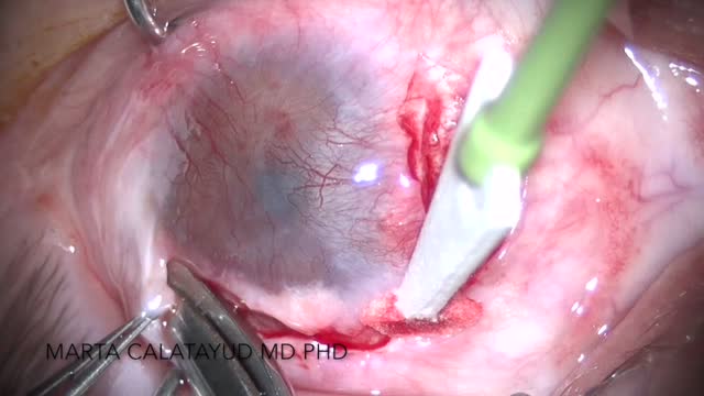 Autolimbal Transplantation