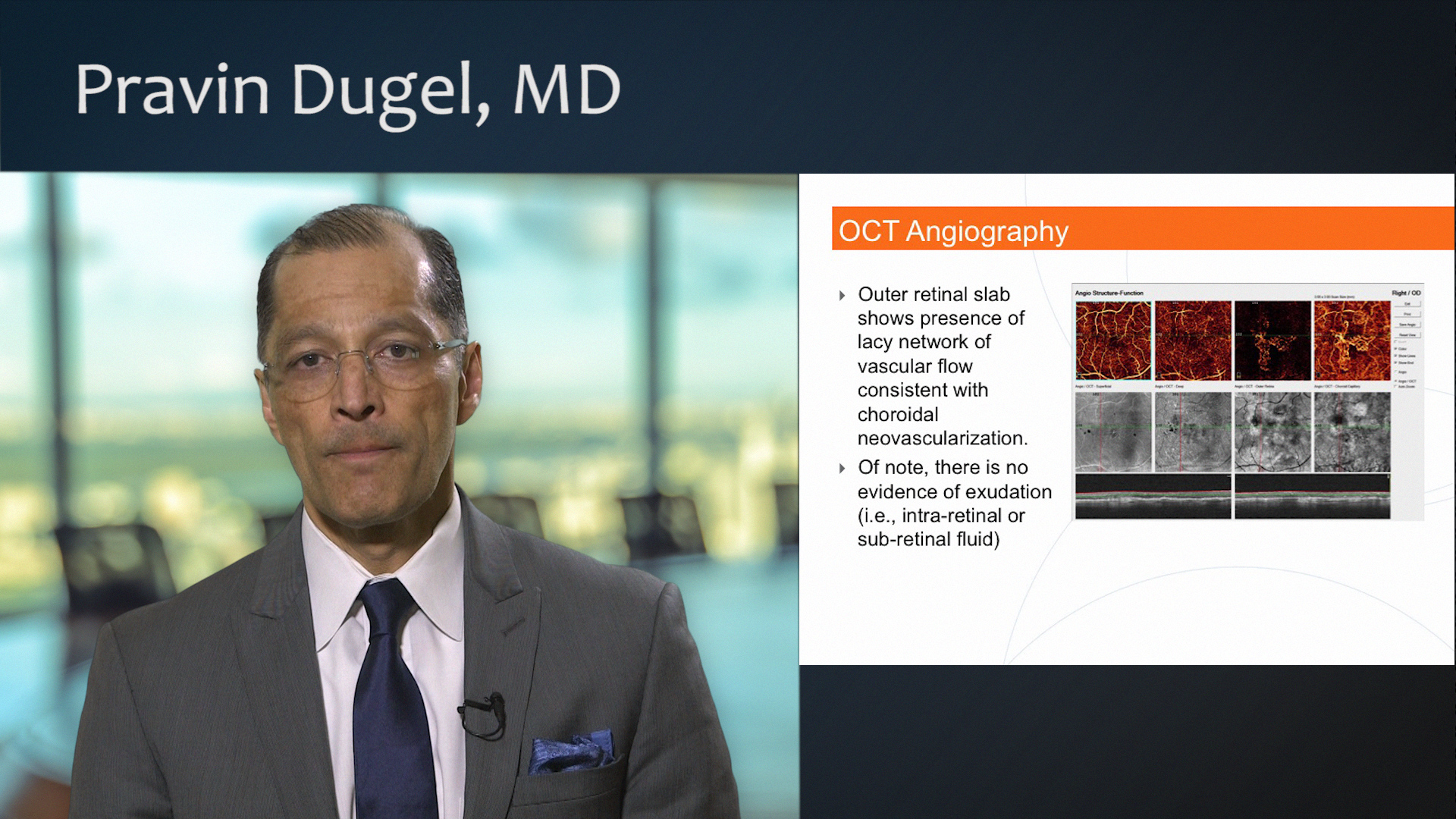 OCTA for a Case of Neovascular AMD