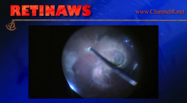 Shaken Baby Syndrome