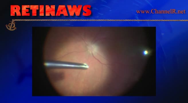 Retinal Detachment & Vasculitis