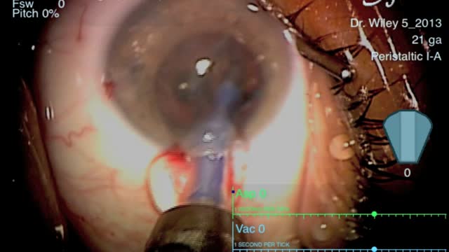 Zero-ultrasound Extraction with the Catalys 