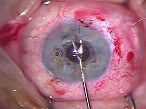 An Anterior Chamber Angle Fixated IOL Exchange for a Crystalens 