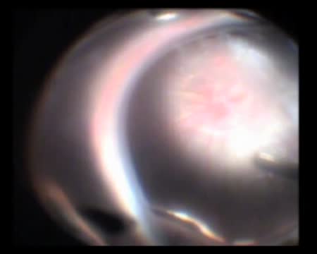 Retinal Detachment Surgery in Morning Glory Syndrome