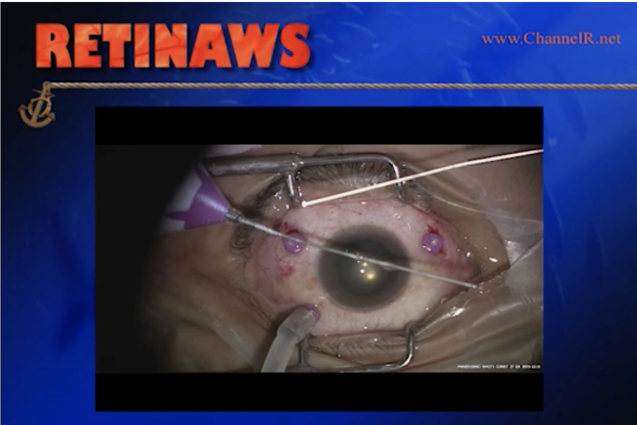 27 Gauge Vitrectomy