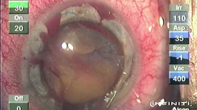 Morgagnian Cataract with Manual Surgery