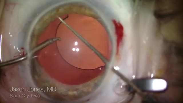 Megalocornea Suture Re-suspension of Decentered IOL