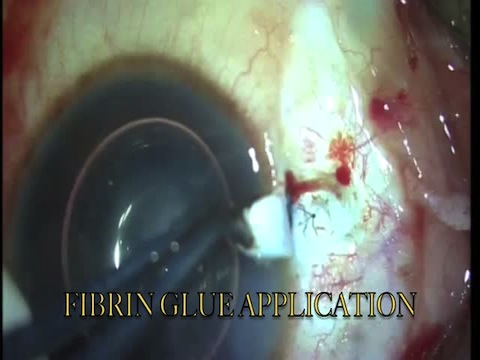 Glued IOL for Lens Coloboma in Marfan's Syndrome
