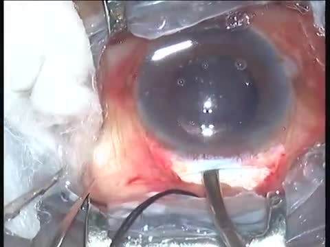 Brunescent Cataract SICS