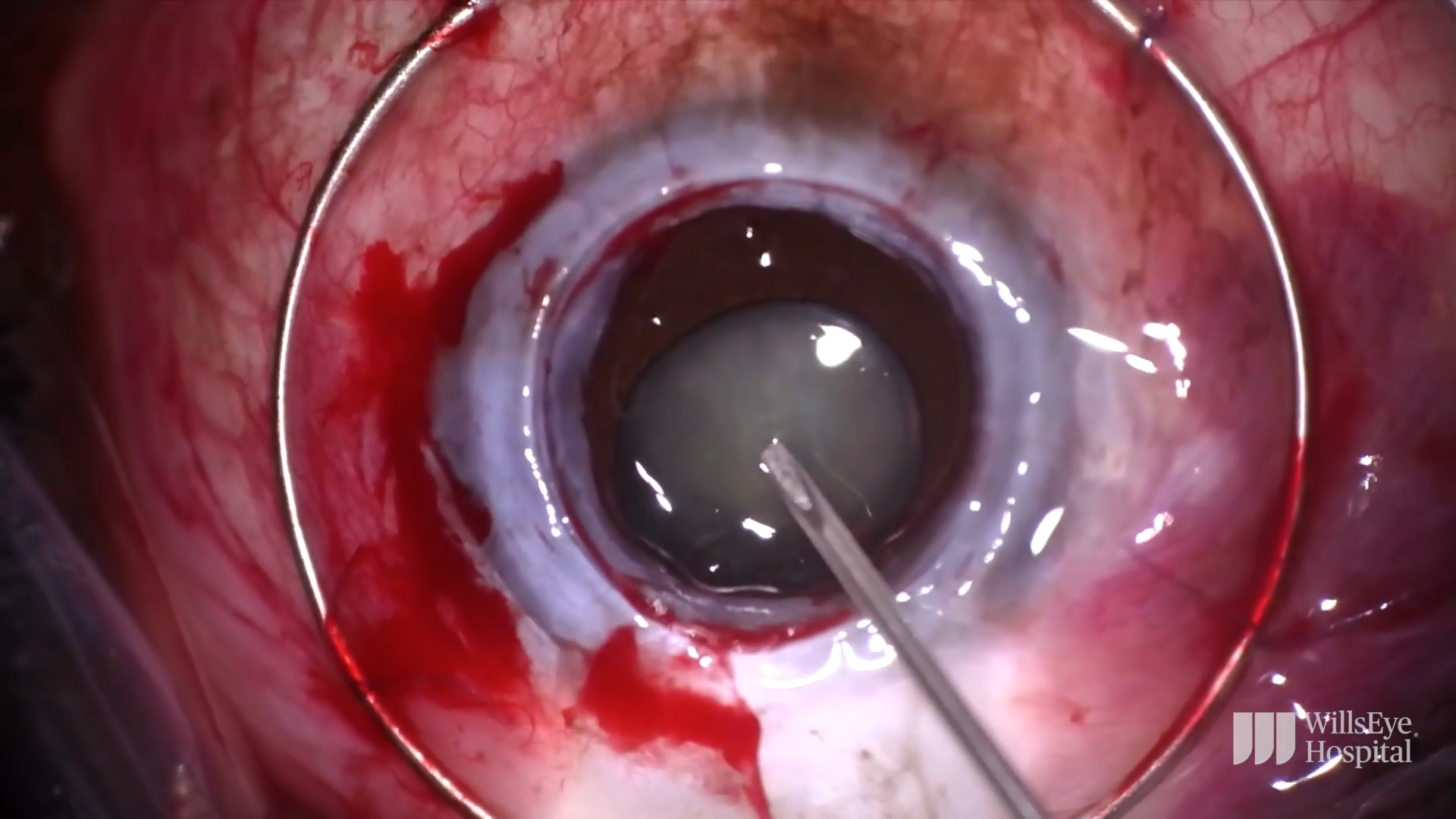 Cataract and a Dense Corneal Scar
