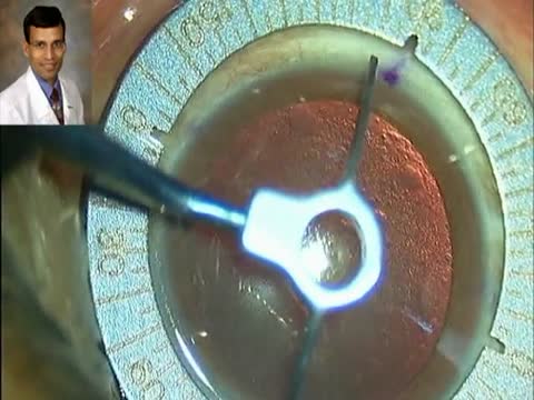 Refractive Lens Exchange With Toric IOL Implantation