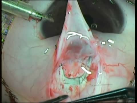 Sturge Weber Syndrome