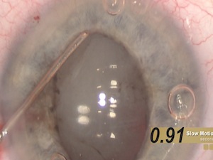 Dropless Cataract Surgery: A Transzonular Approach