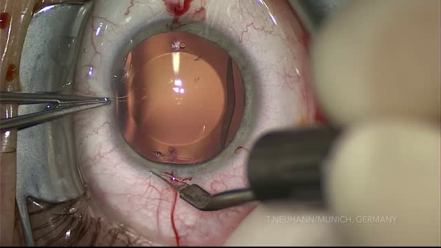 ICL Removal & Replacement With a Toric EVO+ Visian ICL