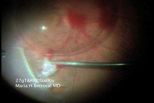 27G Traction and Rhegmatogenous RD