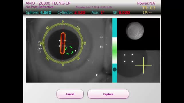 Astigmatic Correction in Laser Cataract Surgery