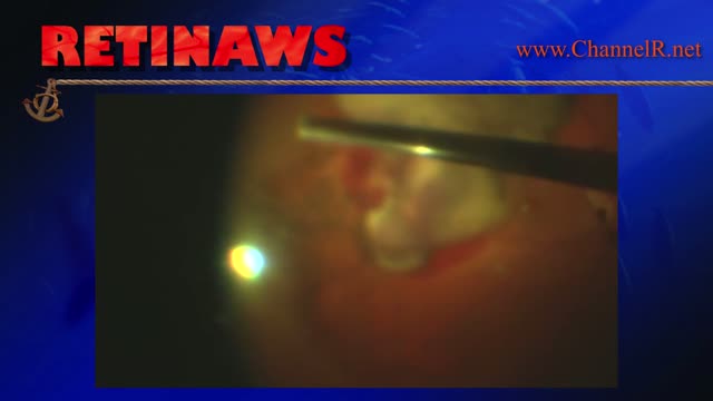 Vitreous Hemorrhage in RAM Syndrome