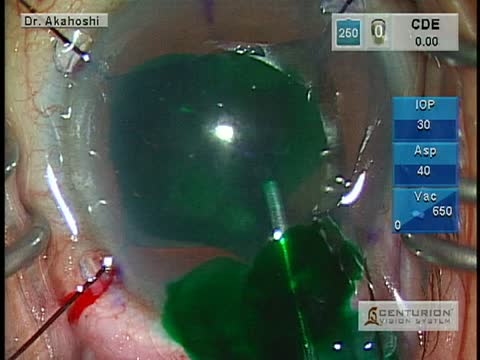 MICS Small Pupil and Hard Cataract