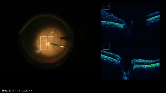 Intraoperative OCT Guided Pars Plana Vitrectomy