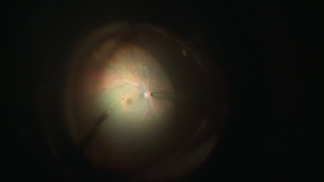 Vitreomacular Traction & Epiretinal Membrane