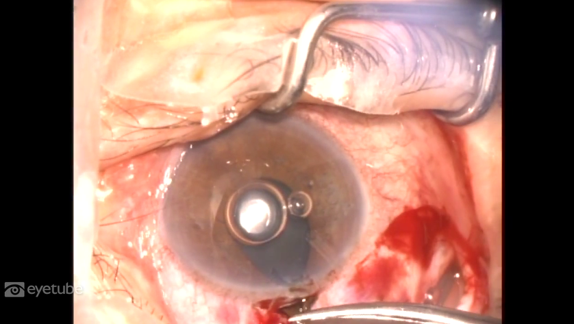Ahmed Valve Implant, Tunnel Technique, & Iridectomy in ACG
