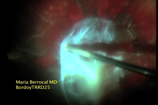 Diabetic TRD 25G Lift & Peel Technique